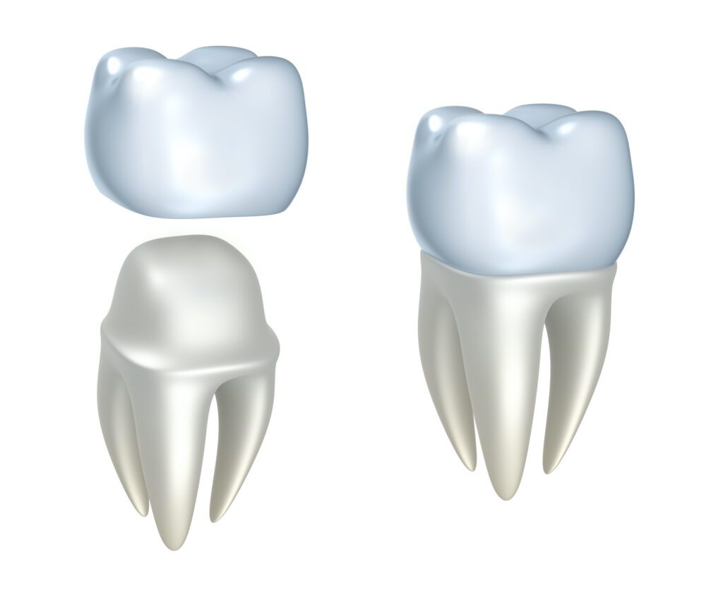 A Dental Crown in Bethesda, MD, can help protect and restore your natural tooth