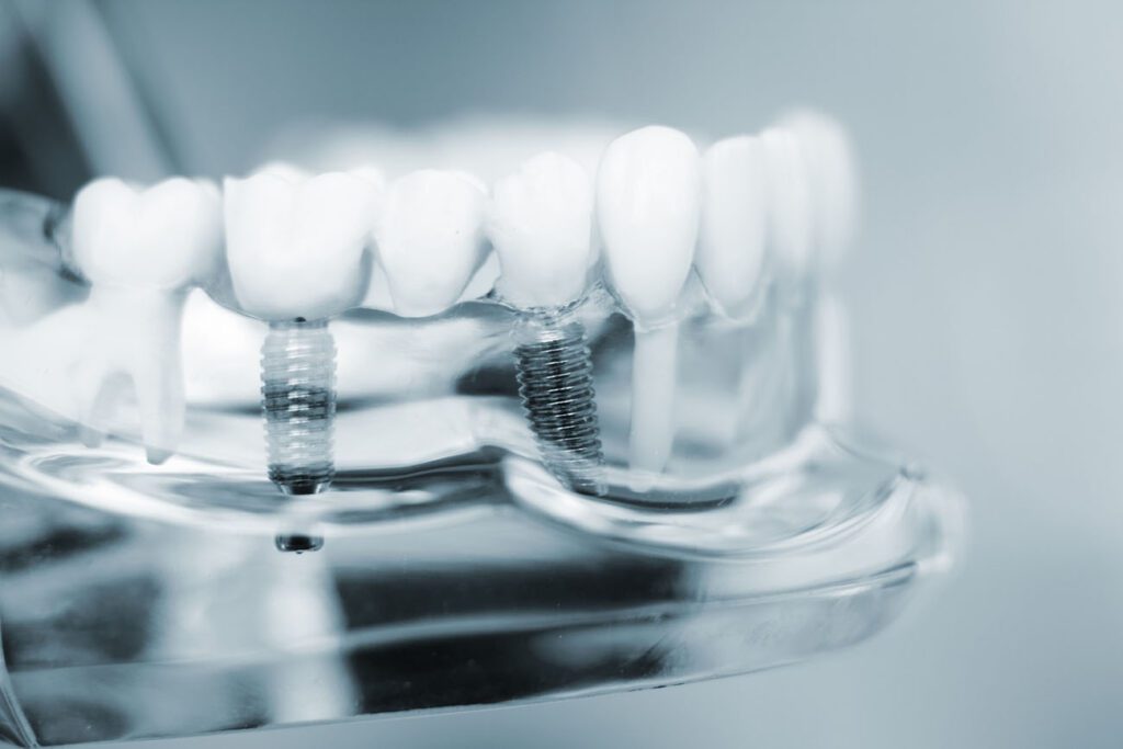 DENTAL IMPLANTS in BETHESDA MD can be extremely beneficial for most patients