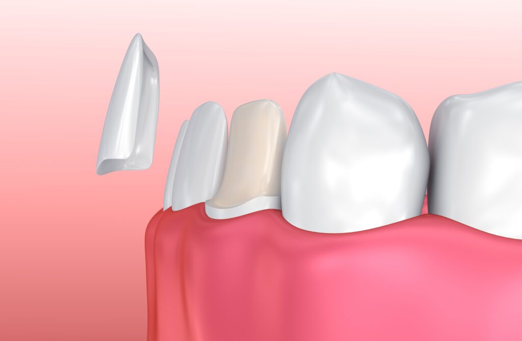 Porcelain Veneers in Bethesda MD could help address many smile imperfections