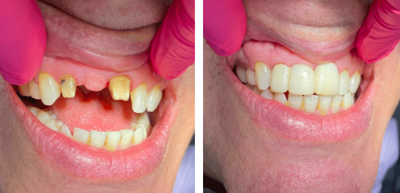 before and after dental implants bethesda md